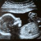 Arzt erkennt Behinderung des Kindes bei Schwangerenvorsorge nicht: Haftung?
