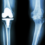 Behandlungsfehler bei Knieprothesen