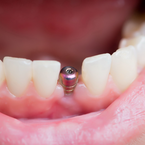 Nervschädigung durch zu langes Zahnimplantat: 8.000 Euro
