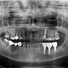 Zahnimplantat - Nervus alveolaris inferior - Sensibilitätsstörung