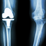 Behandlungsfehler bei Knieprothesen